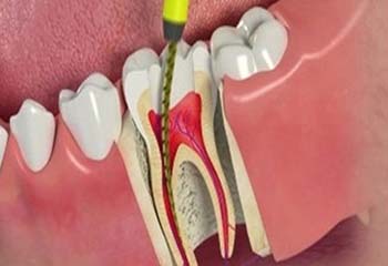  آشنایی با عمل کانال ریشه دندان یا عصب کشی 